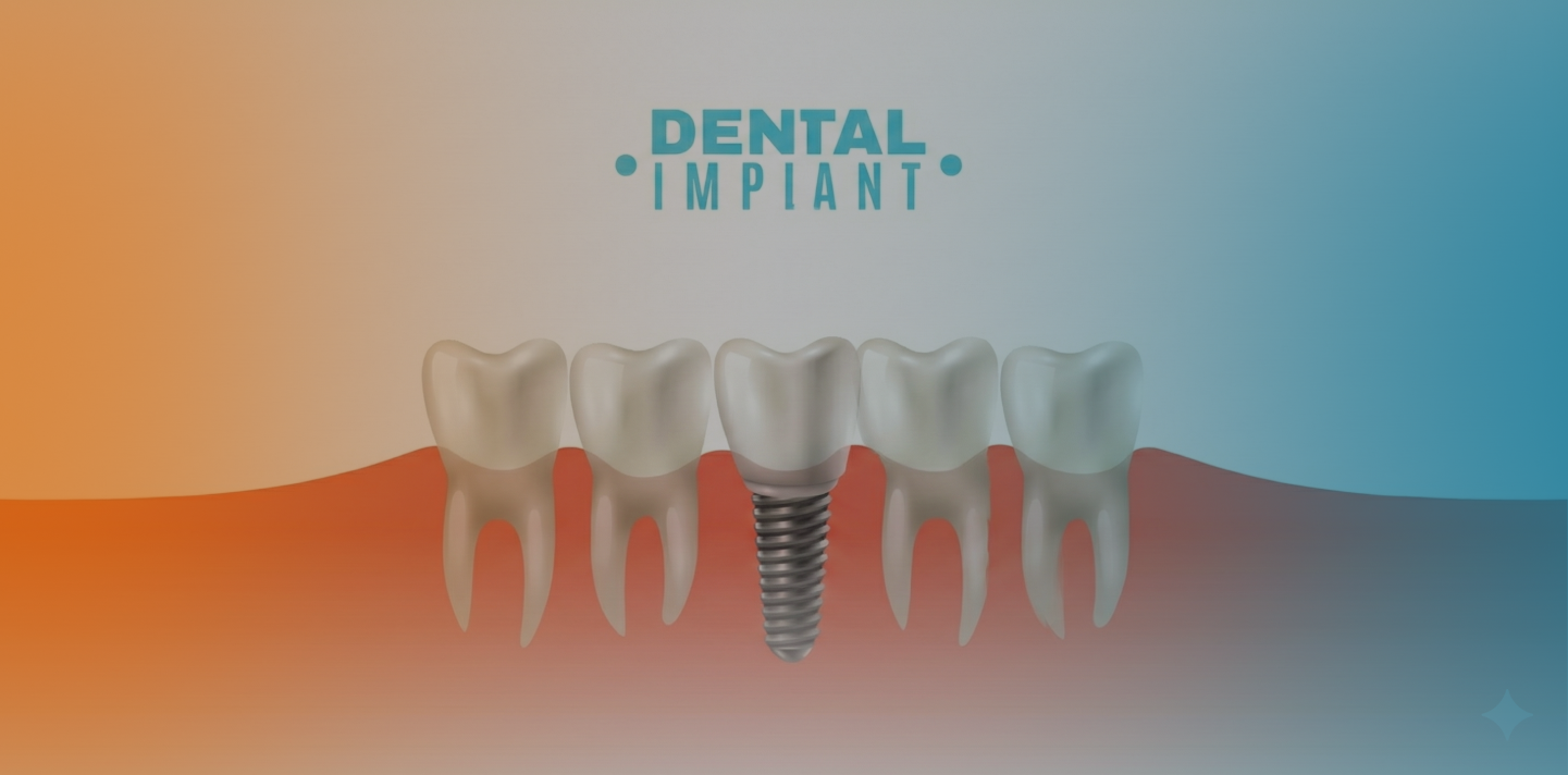 Dental implant replacing a missing tooth between natural teeth