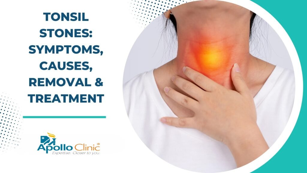 Tonsil Stones : Symptoms